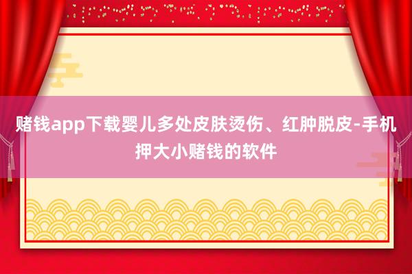 赌钱app下载婴儿多处皮肤烫伤、红肿脱皮-手机押大小赌钱的软件